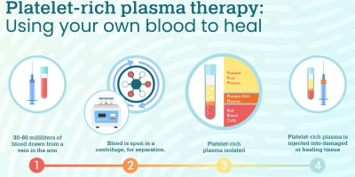 Accelerate Healing with Platelet-Rich Fibrin (PRF) Therapy: Faster Recovery in Dental Procedures