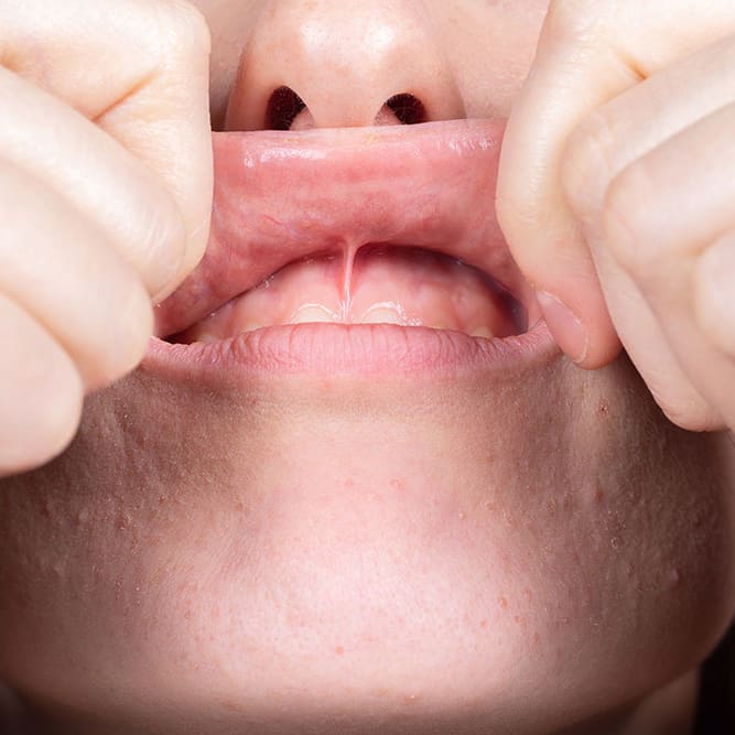 Frenectomies and the importance of them? 