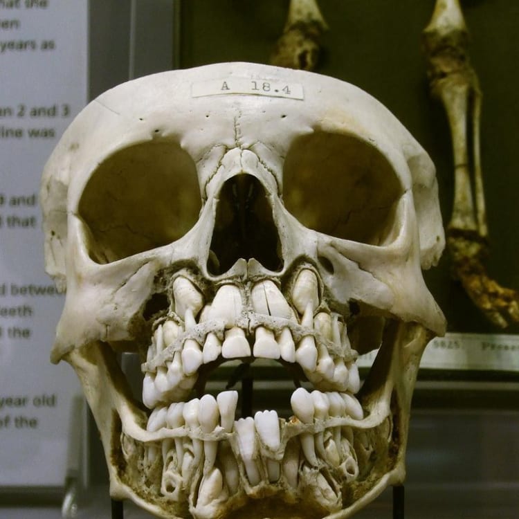 19th Century Child Skull