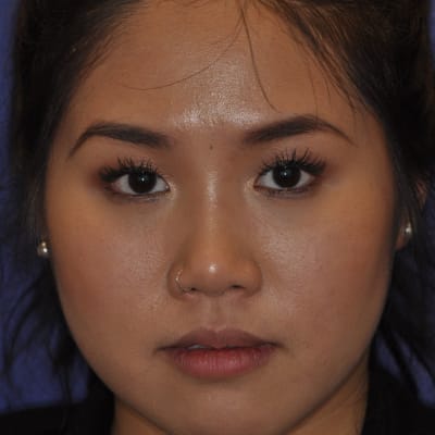 Before: Botox for jaw pain