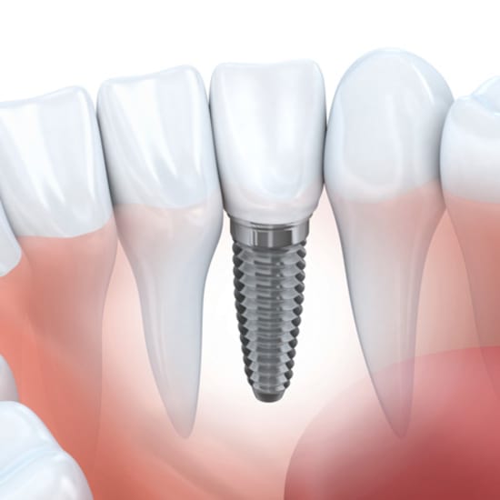 Kelowna Dental Implants for Missing Teeth